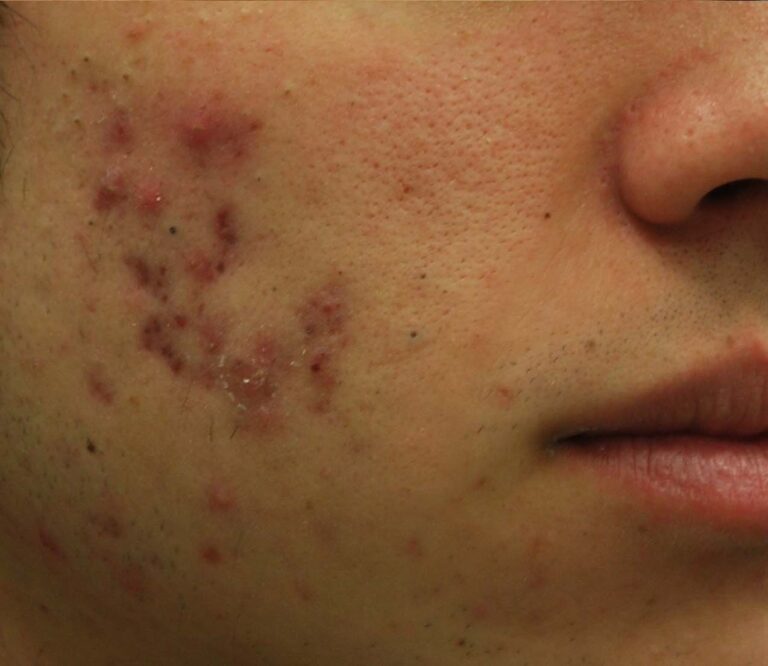 Before Image: Face - right-front-oblique