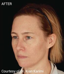 After Image: Microneedling with PRF