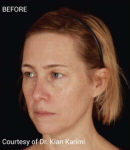 Before Image: Microneedling with PRF