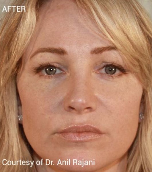 After Image: Microneedling with PRF - front