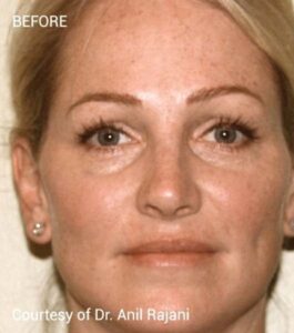 Before Image: Microneedling with PRF