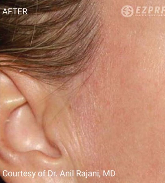 After Image: Microneedling with PRF - right-side