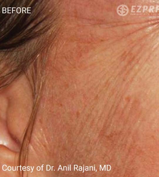 Before Image: Microneedling with PRF - right-side