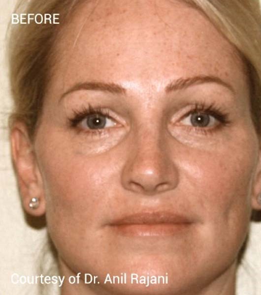 Before Image: PRF Filler - front
