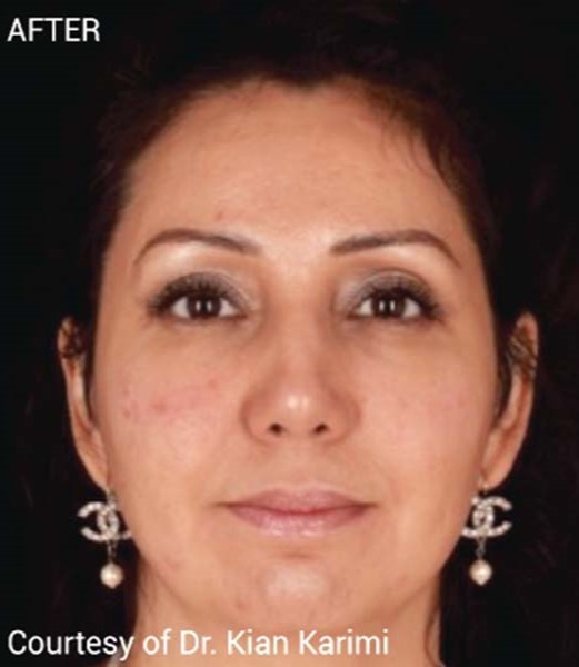 After Image: PRF Filler - front