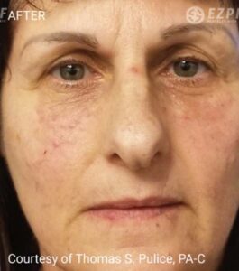 After Image: PRF Filler