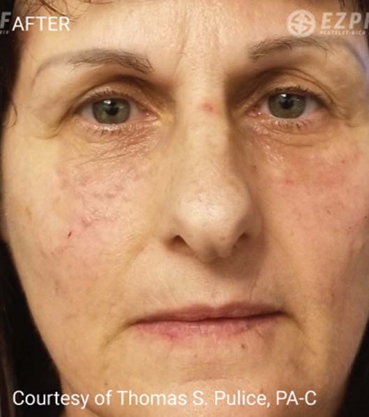 After Image: PRF Filler - front