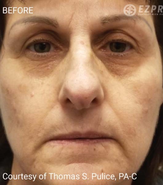 Before Image: PRF Filler - front