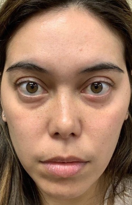 After Image: PRF Filler - front