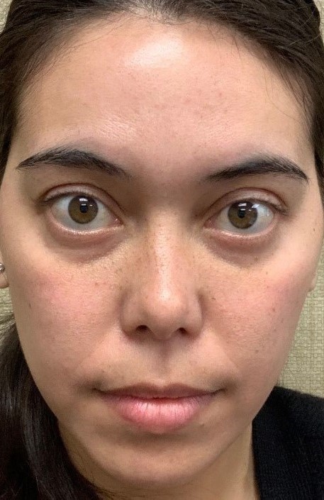 Before Image: PRF Filler - front