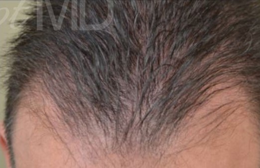 After Image: PRP Hair Restoration - front