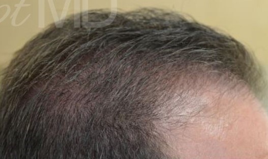 After Image: PRP Hair Restoration - right-side