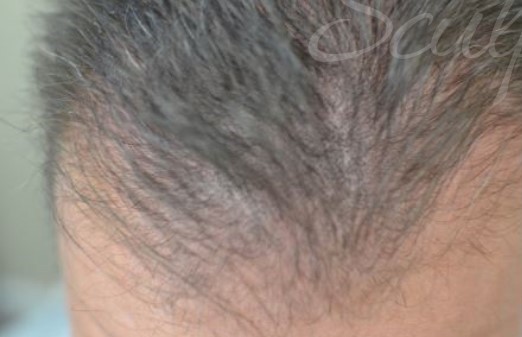 Before Image: PRP Hair Restoration - front