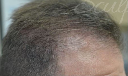 Before Image: PRP Hair Restoration - right-side