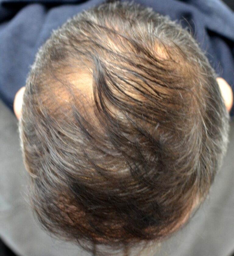 After Image: PRP Hair Restoration - front
