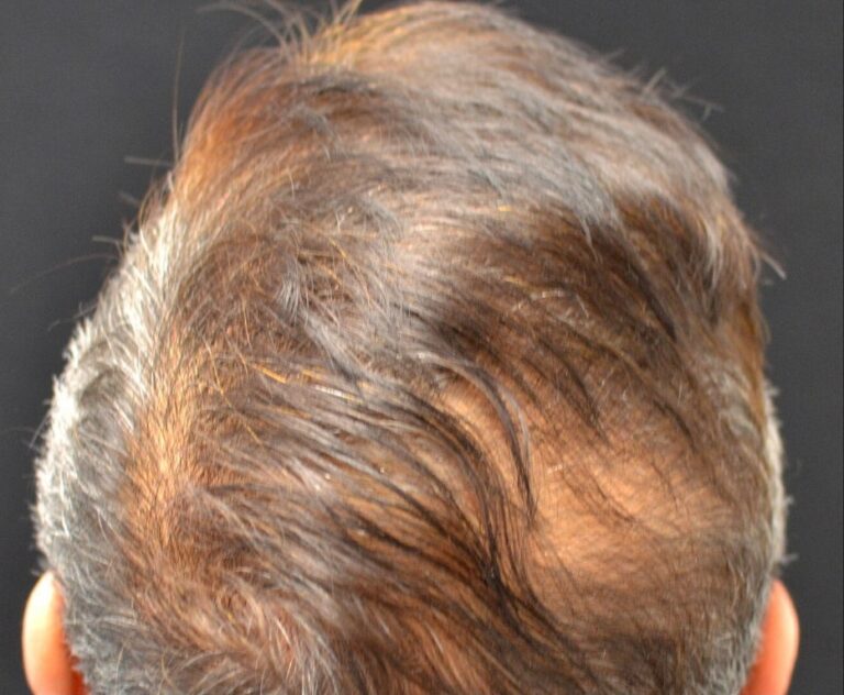 After Image: PRP Hair Restoration - front