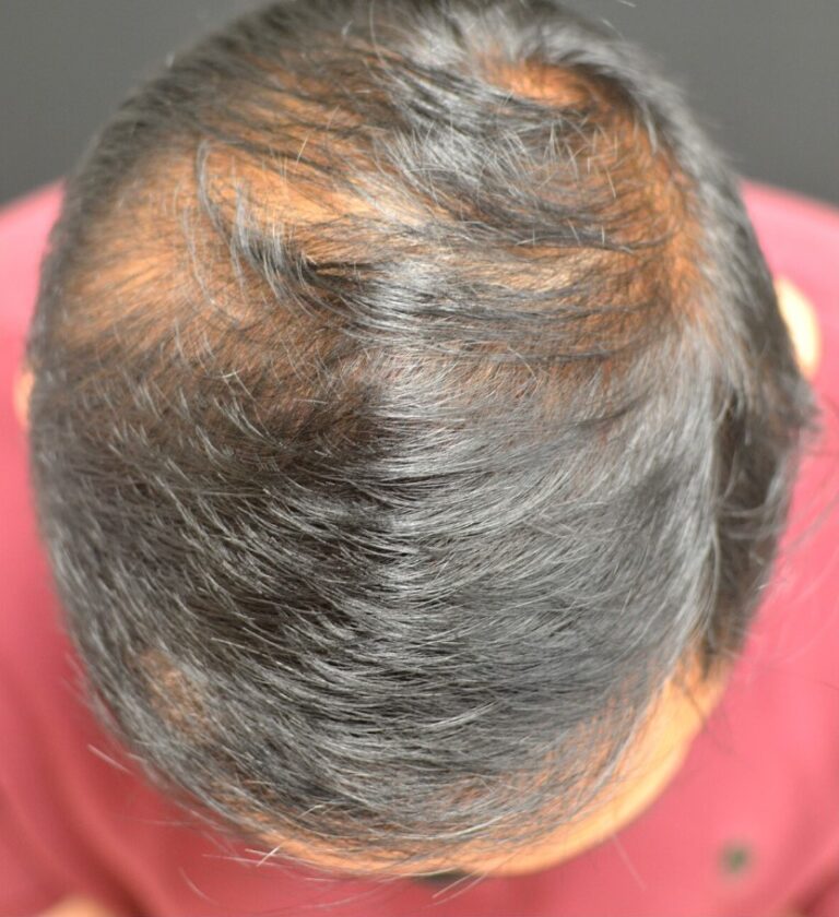 Before Image: PRP Hair Restoration - front
