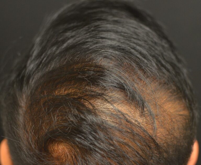 Before Image: PRP Hair Restoration - front