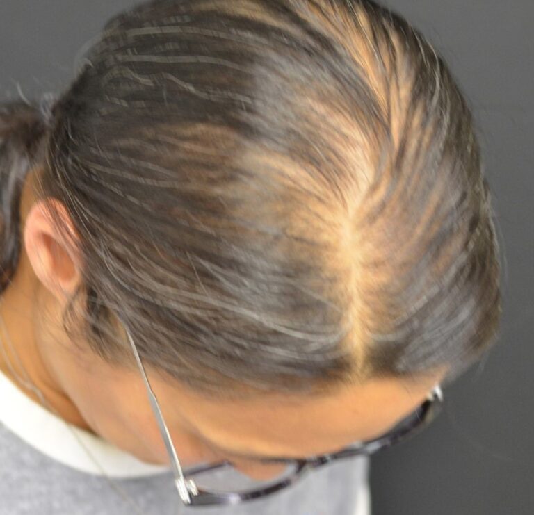 After Image: PRP Hair Restoration - right-back-oblique