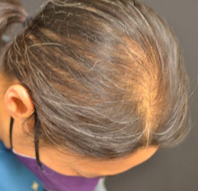 Before Image: PRP Hair Restoration - right-back-oblique