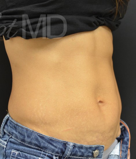 After Image: Abdomen - right-front-oblique