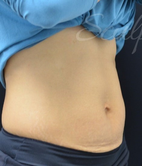 Before Image: Abdomen - right-front-oblique