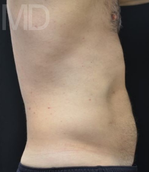 After Image: Abdomen - right-side