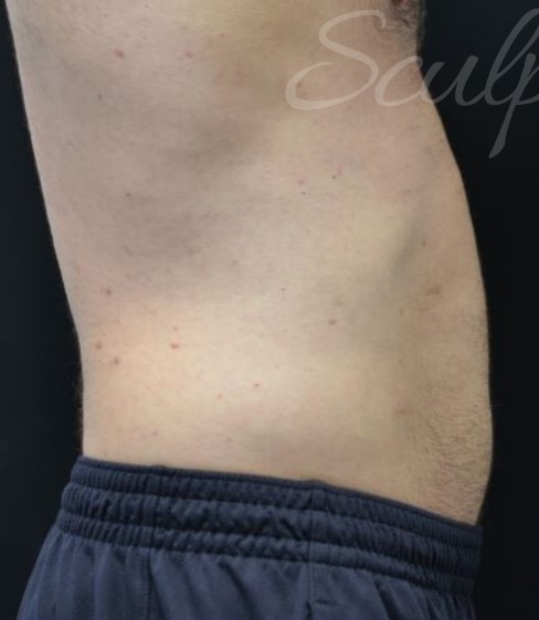 Before Image: Abdomen - right-side