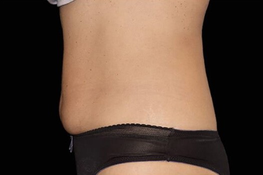 After Image: Abdomen - left-side