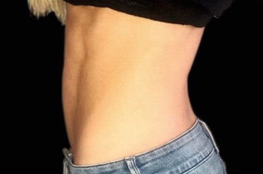 After Image: Abdomen - left-side