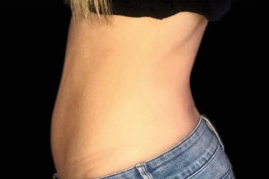 Before Image: Abdomen - left-side