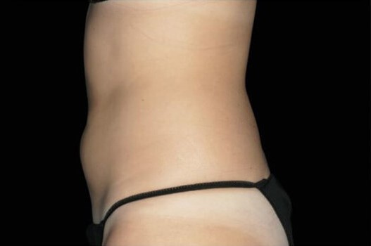 After Image: Abdomen - left-side