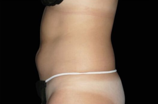 Before Image: Abdomen - left-side