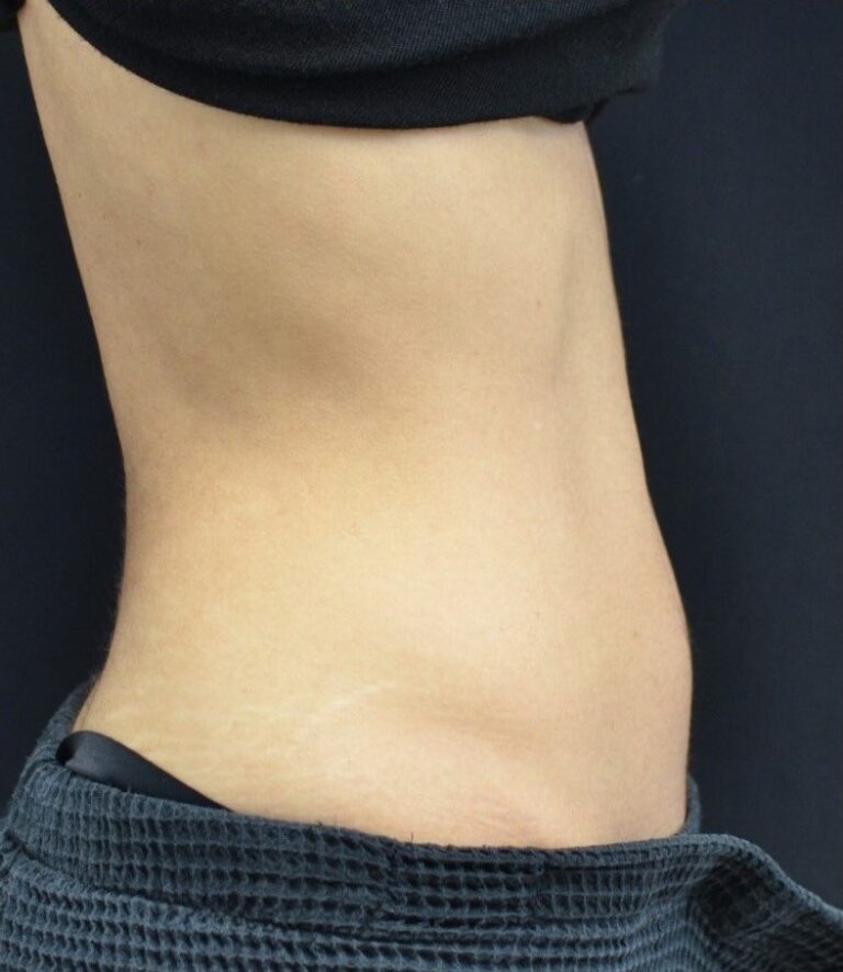 After Image: Abdomen - right-side
