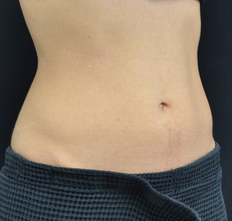 After Image: Abdomen - right-front-oblique