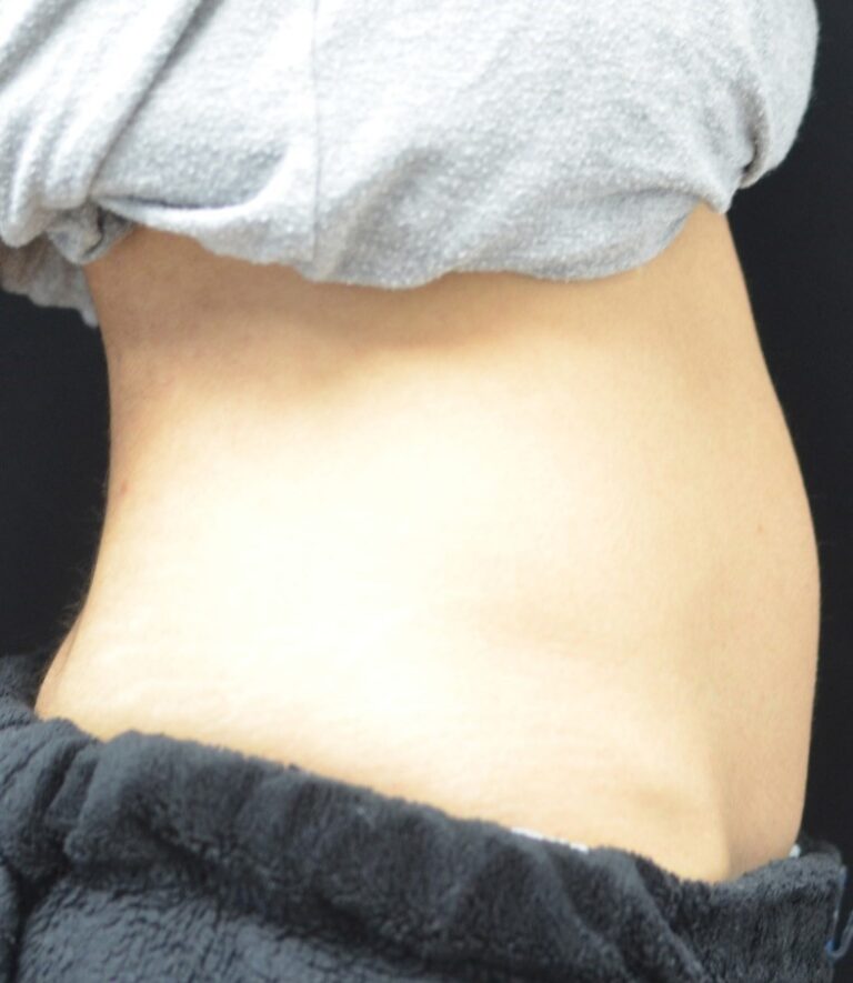 Before Image: Abdomen - right-side