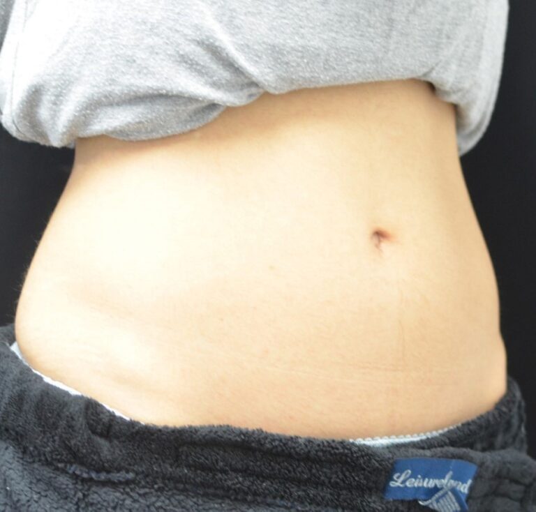 Before Image: Abdomen - right-front-oblique