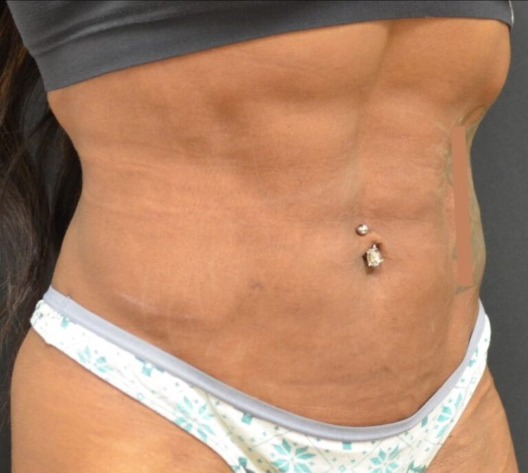 After Image: Abdomen - right-front-oblique