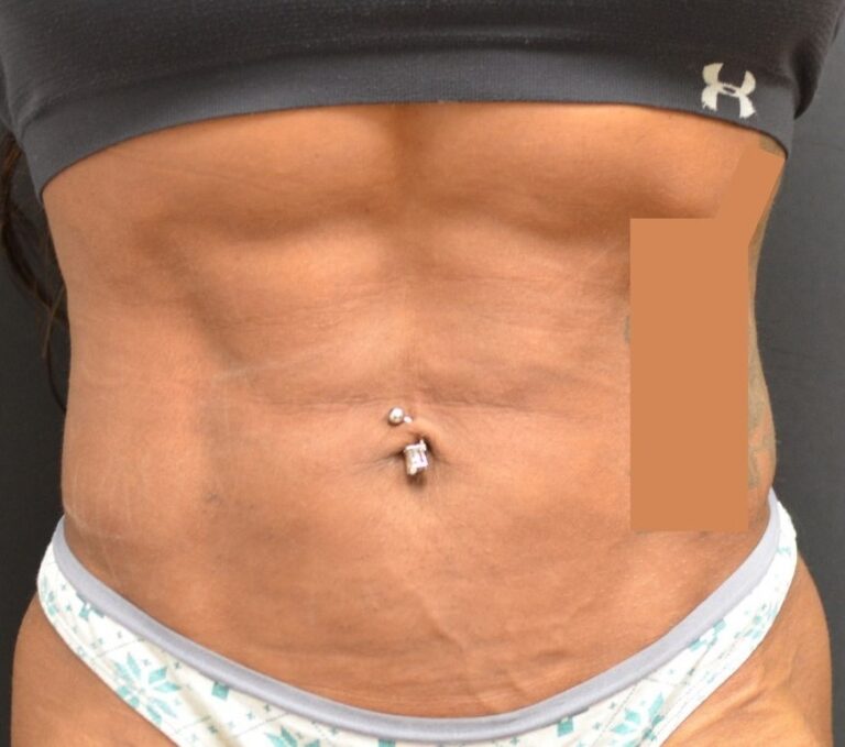 After Image: Abdomen - front