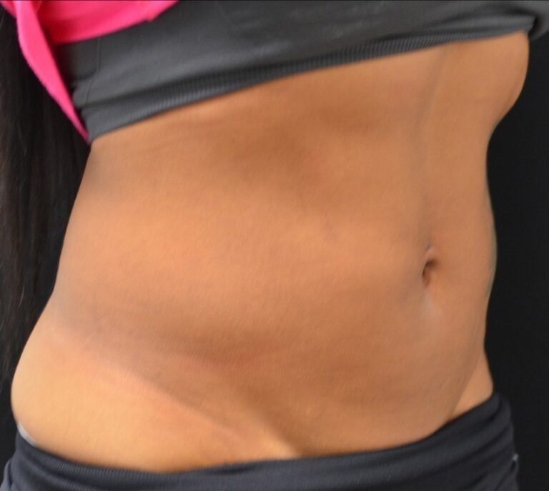 Before Image: Abdomen - right-front-oblique
