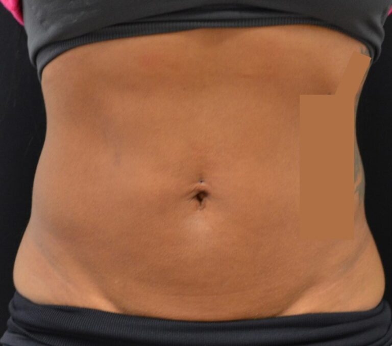 Before Image: Abdomen - front