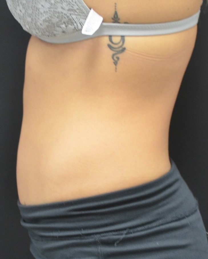 After Image: Abdomen - left-side