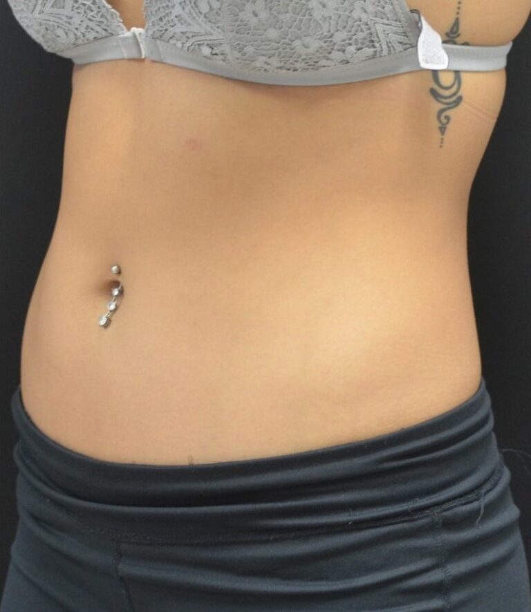 After Image: Abdomen - left-front-oblique