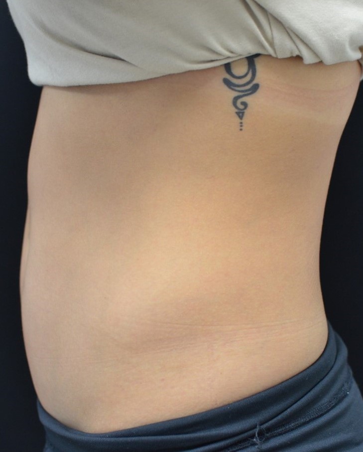 Before Image: Abdomen - left-side