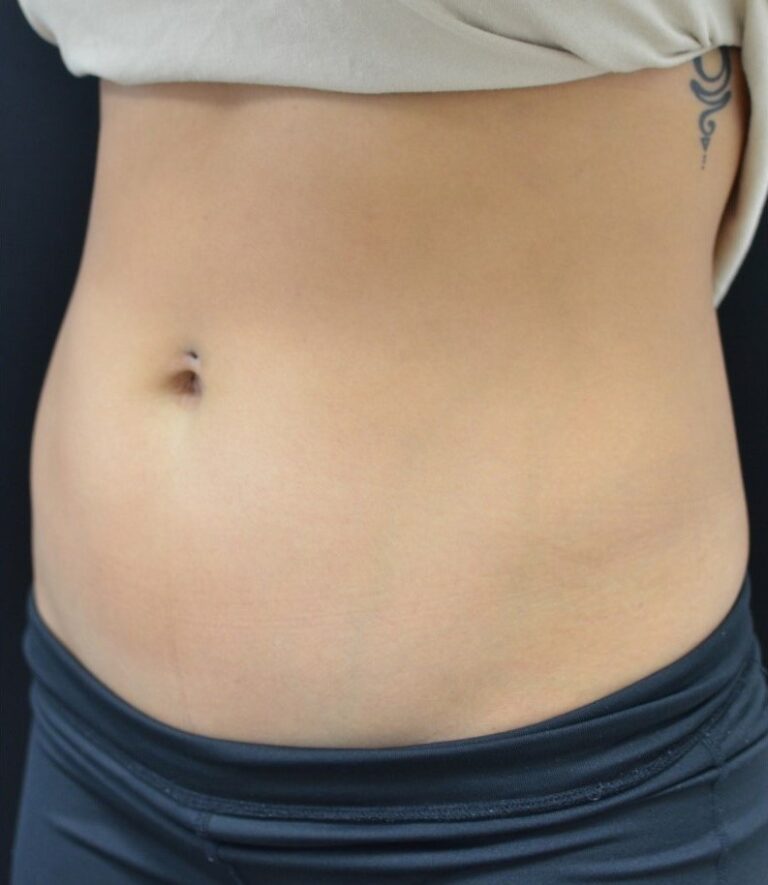 Before Image: Abdomen - left-front-oblique