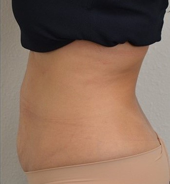 After Image: Abdomen - left-side