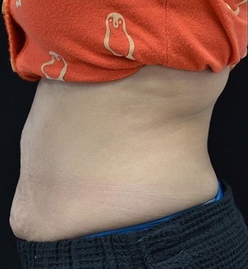 Before Image: Abdomen - left-side