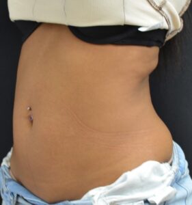After Image: Abdomen