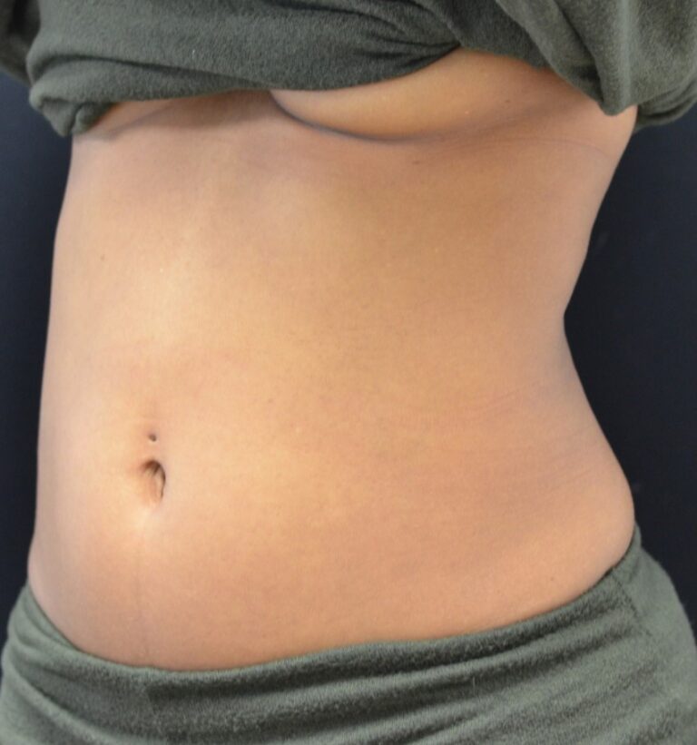 Before Image: Abdomen - left-front-oblique