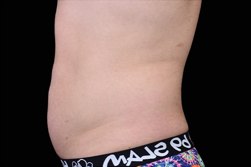 After Image: Abdomen - left-side